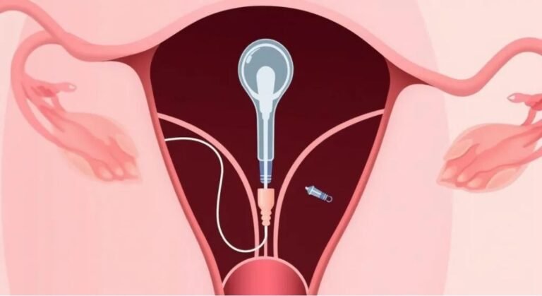 How Effective Are IUDs for Birth Control and Menstrual Health?